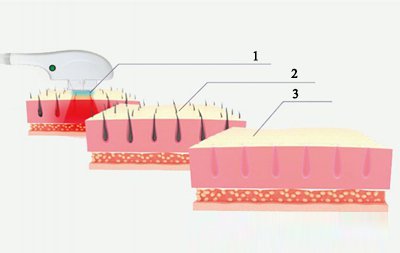 جهاز نبضات الضوء المكثف SHR/OPT/AFT