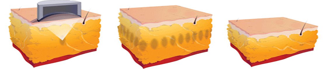 جهاز تفتيت الدهون Liposonix